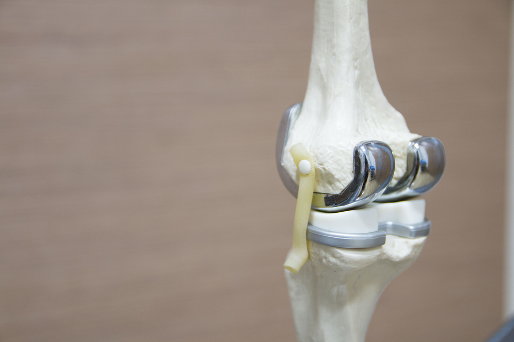 outpatient joint replacement surgery