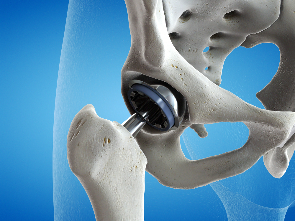 hip replacement