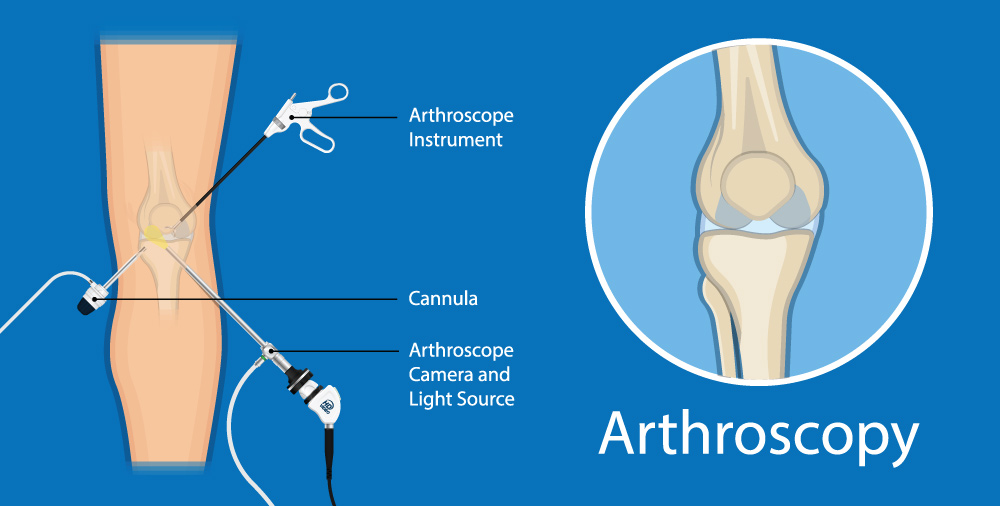 Knee/Shoulder Arthroscopy in Burbank