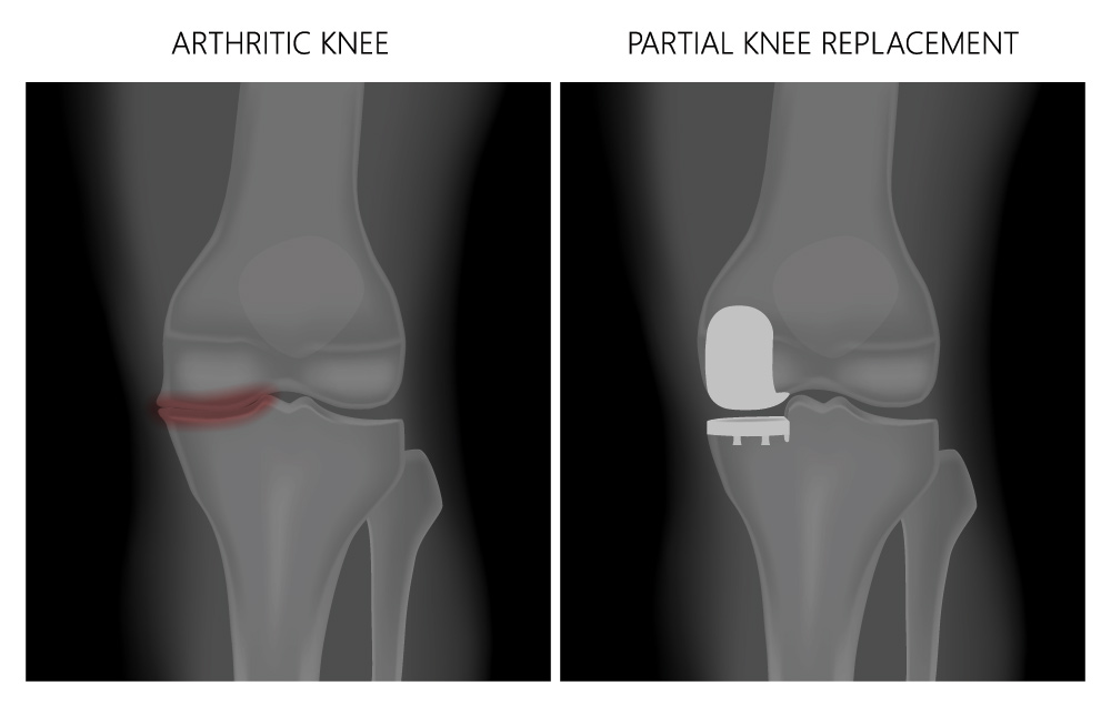 Partial Knee Replacement in Burbank