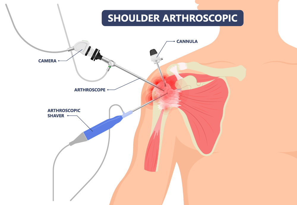 Knee/Shoulder Arthroscopy in Burbank